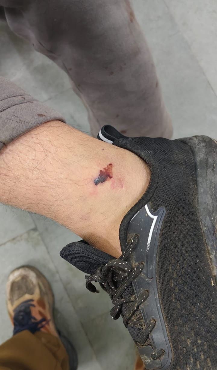 पैर में लगी चोट