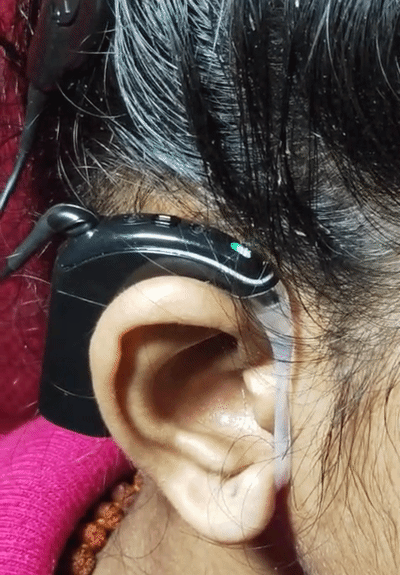 कॉक्लियर इम्प्लांट आपरेशन के बाद खुशी घर आई। अब वह बोलकर अपनी मां से पंसदीदा खाना बनवाती है।