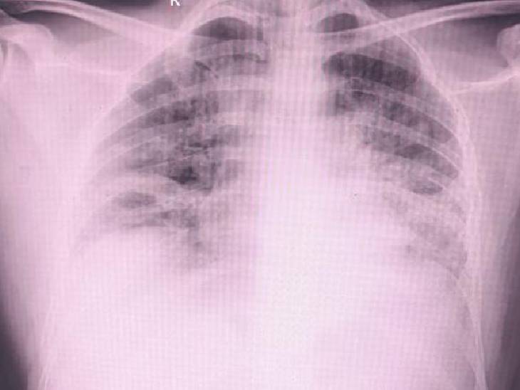 एक्स-रे में फेफड़े में दिखा प्रोटीन और धूल।