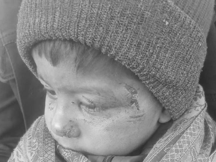 ये तस्वीर 9 जनवरी की है जब बच्चे को कुत्ते ने काट लिया था।