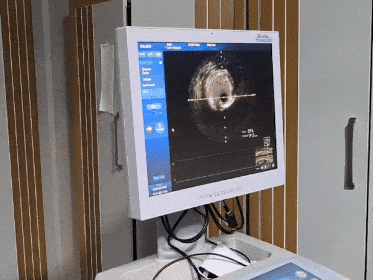 हमीदिया अस्पताल में IVUS और FFR तकनीक का इस्तेमाल शुरू हो गया है।