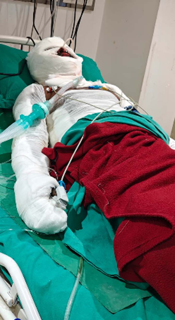 गंभीर रूप से घायल मजदूरों का रायपुर के अस्पताल में इलाज जारी है।