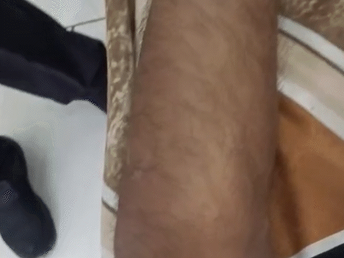 इंजेक्शन से ही हुई कपड़ा व्यापारी की मौत:  पोस्टमॉर्टम की प्रारंभिक रिपोर्ट में खुलासा, 2 पर स्टडी चल रही; होटल में मरा छोड़ भागी थी गर्लफ्रेंड – Hisar News