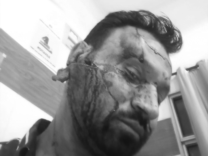 किरपान लगने के कारण हरजीत सिंह का कटा कान और चेहरा। -