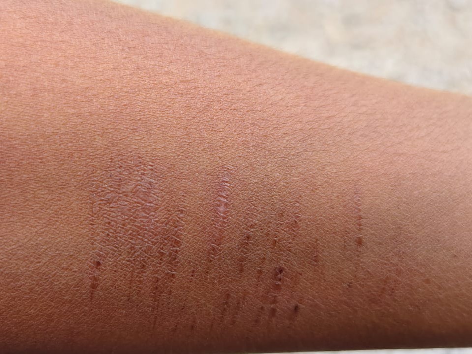 एक एक बच्चों के हाथ में 15020 कट के निशान थे।