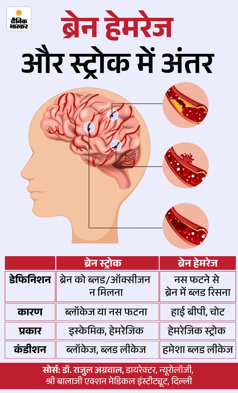 Salim Khan Health Update; Brain Hemorrhage Reason, Risk Factors 18 whatsapp image 2026 02 23 at 103219 am 1771823002 -