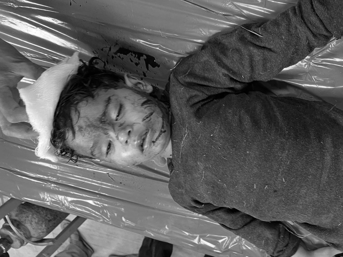 कुत्तों के हमले से बुरी तरह से जख्मी इस्माइल
