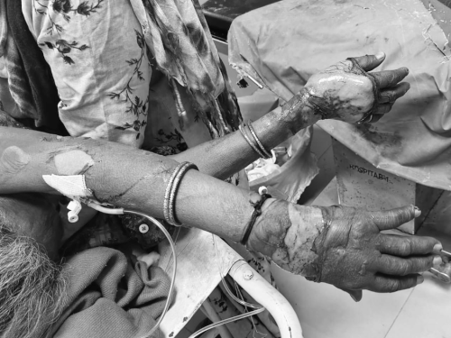 महिला के हाथ-पैर जले हुए हैं और शरीर पर सूजन आ गई है।