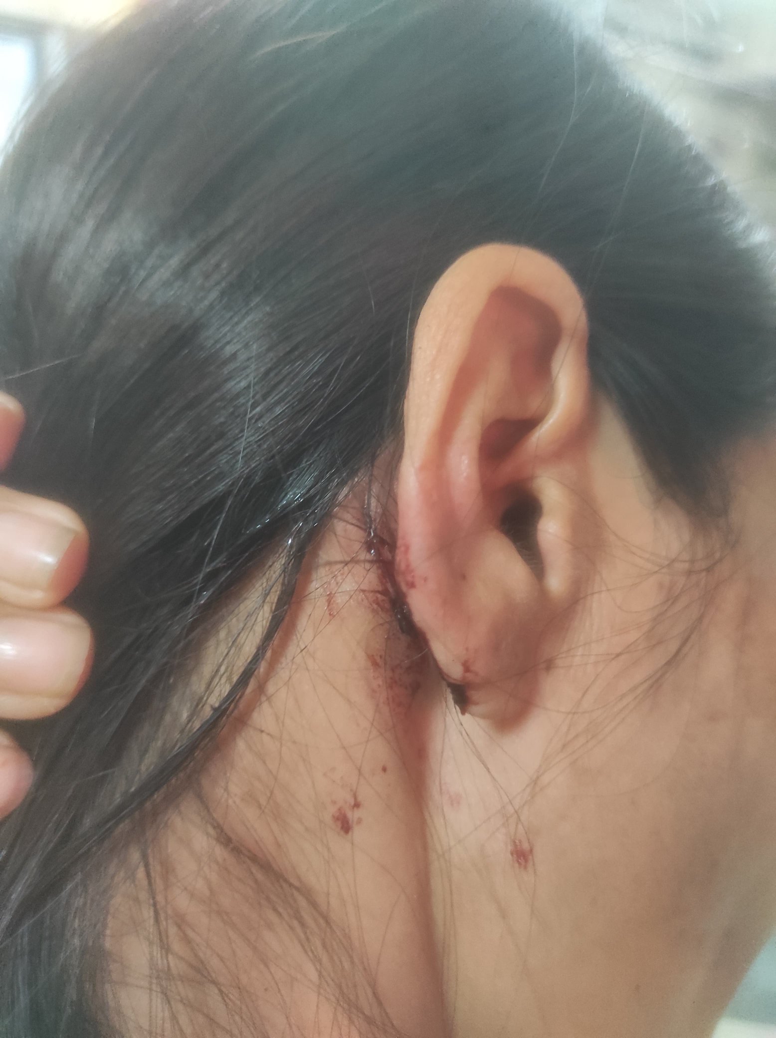 मारपीट के दौरान पीड़ित युवती के कान के पीछे जख्म हुआ।