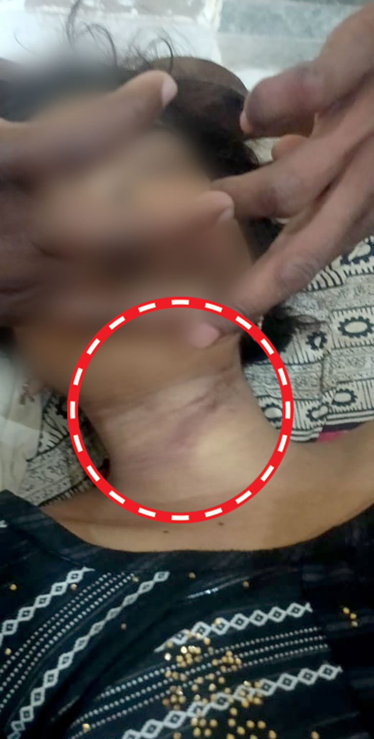 पुलिस को लड़की के गले पर कसने का निशान मिला।
