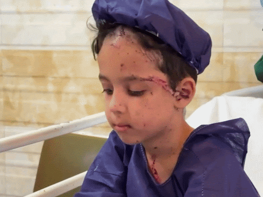 ईरान पर अमेरिकी-इजराइली हवाई हमलों में घायल हुई बच्ची का तेहरान के एक अस्पताल में इलाज चल रहा है। उसके चेहरे और गर्दन पर जख्म के निशान हैं।