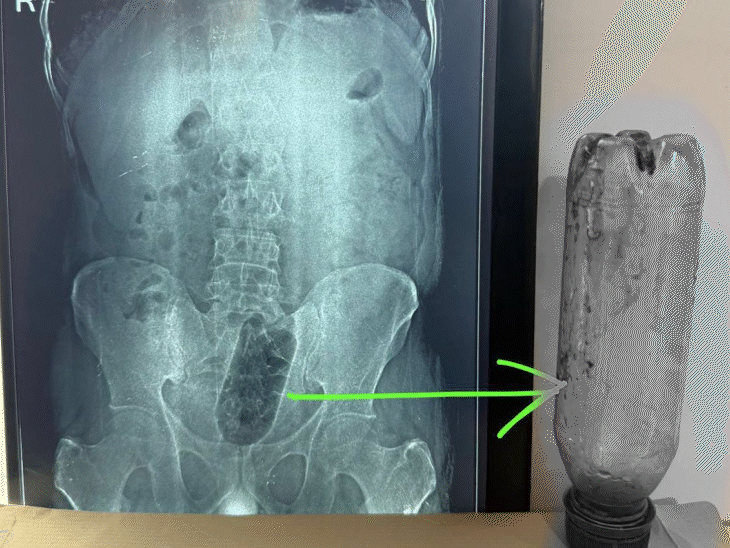 एक्सरे करने के बाद डॉक्टर ने युवक की सर्जरी की। फिर बोतल को बाहर निकाला।