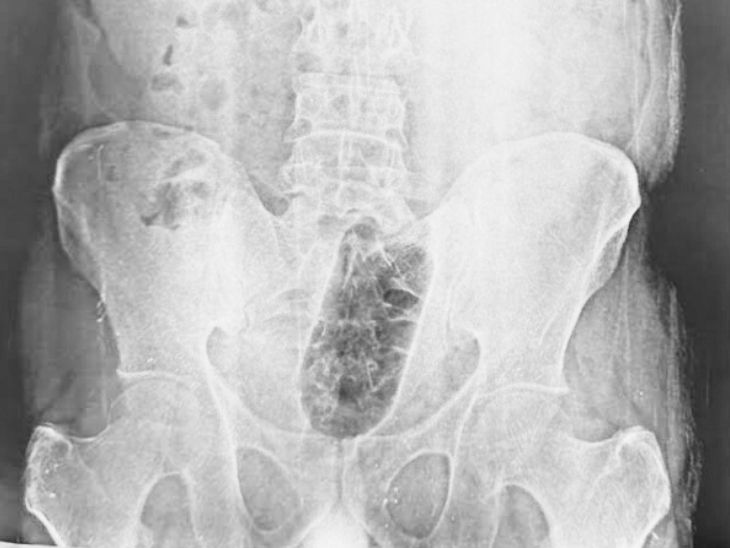 डॉक्टर ने एक घंटे तक सर्जरी की। इसके बाद बोतल को बाहर निकाला।