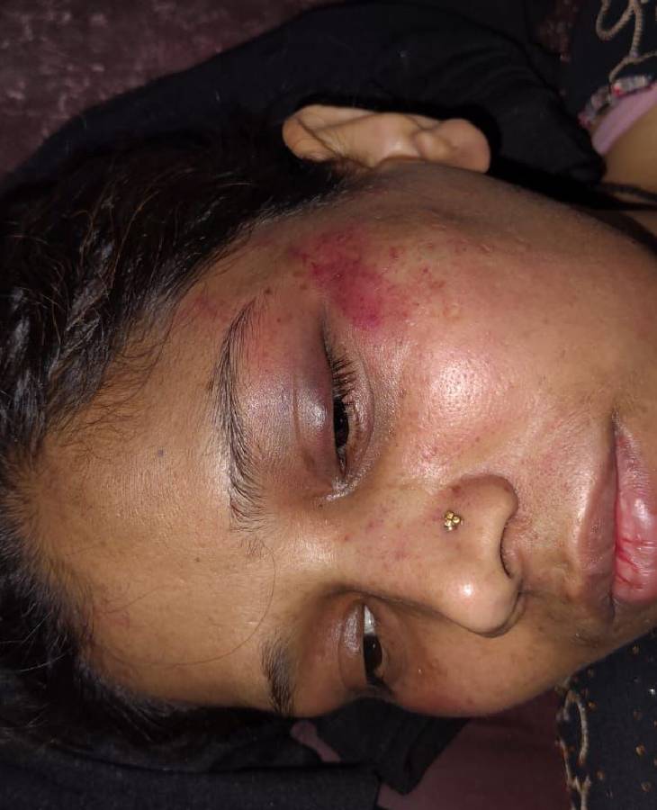 सनिगवां निवासी पीड़ित महिला ने चेहरे पर चोट के निशान दिखाए।