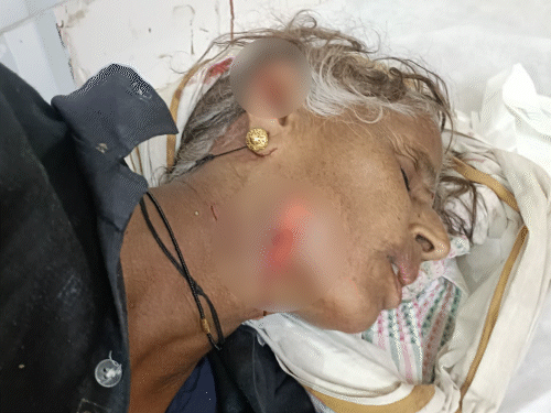 गर्दन के साथ चेहरा को दातों से दबोचने के निशान।