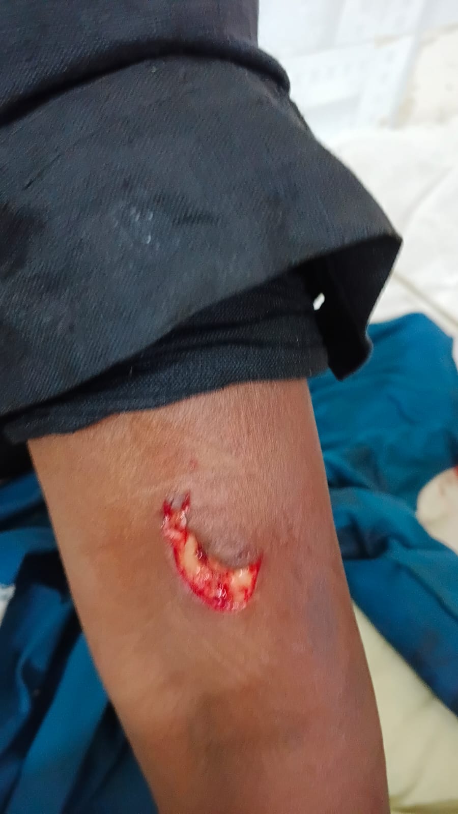 हाथ पर दांत-पंजे के निशान।