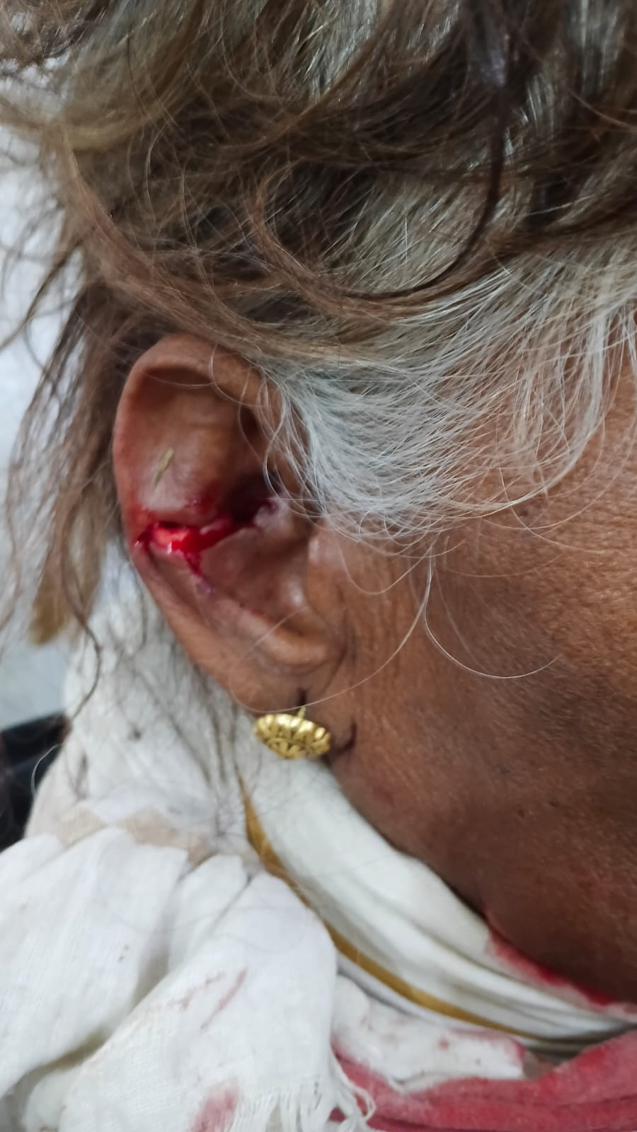 कान पर दांत के निशान।