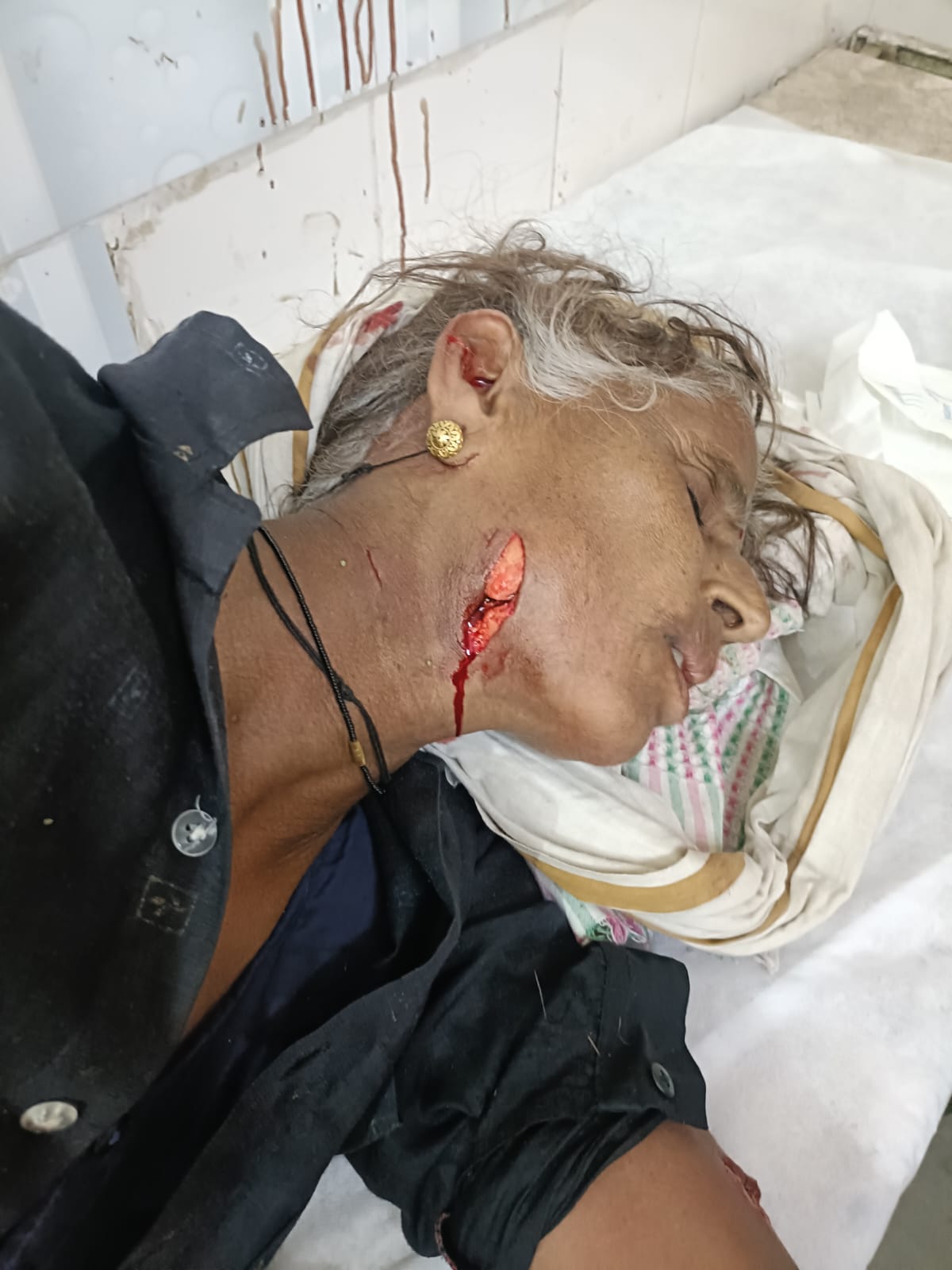 गर्दन के साथ चेहरा को दातों से दबोचने के निशान।