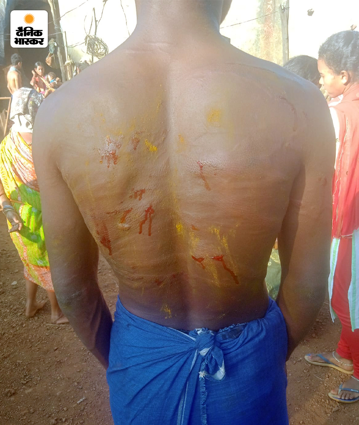 पिटाई से एक शख्स की पीठ की हालत।