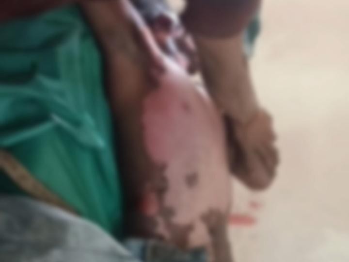 झुलसा हुआ युवक