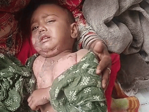 झुलसने के बाद दर्द से कहराती हुई बच्ची। - Dainik Bhaskar