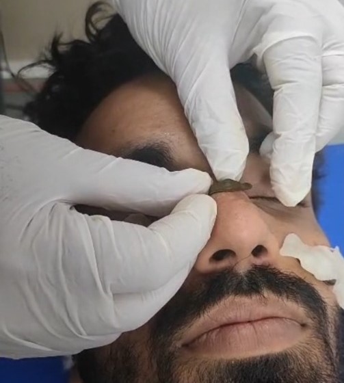 अमजस ने दोस्तों की सलाह पर मुंहासों के लिए इलाज के लिए थेरेपी शुरू कराई।