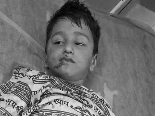 शिवम के होंठ व निचले हिस्से में 15 टांके आए हैं वहीं कान पर 5 टांके आए हैं।