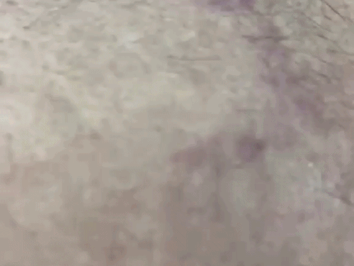 शरीर पर पड़े निशान दिखाता सरबजीत बिंद्रा।