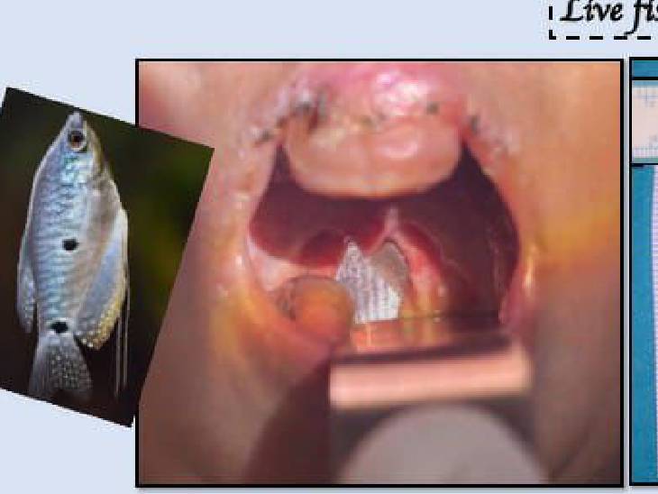 मछली बच्चे के गले में पीछे जाकर फंस गई थी। वह न रो पा रहा था न सांस ले पा रहा था।