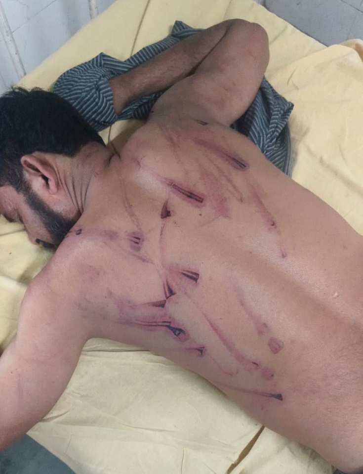 Bruise marks on the driver's body