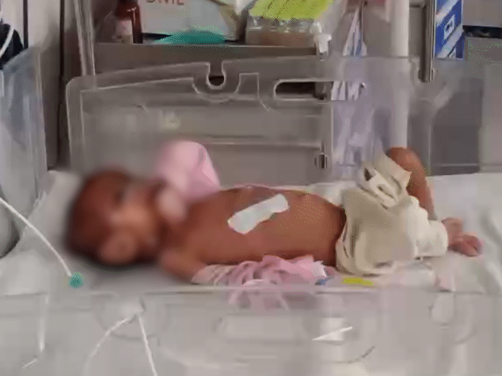 बच्ची गंभीर कुपोषित है। जन्म से एक कान भी विकसित नहीं हुआ है।