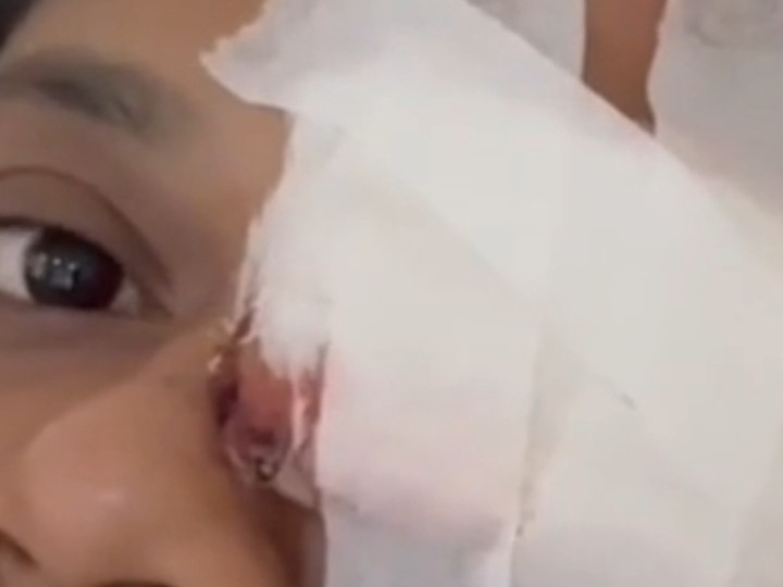 शनिवार को हुए हमले में महिला की आँख पर गंभीर चोट आई थी