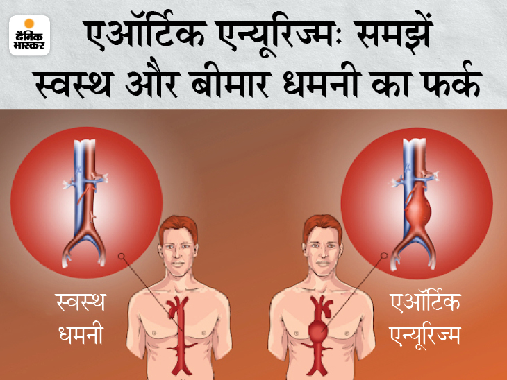 आमतौर पर एऑर्टिक एन्यूरिज्म का पता लगाने के लिए अल्ट्रासाउंड किया जाता है। फूली हुई धमनियां इस बीमारी के होने का संकेत देती हैं।