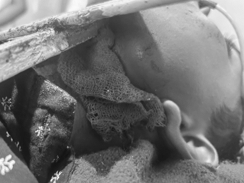 The student was brought to Indore with the angle still attached, where surgery was performed.