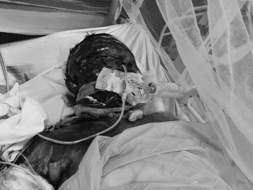 हादसे में झुलसे तीन मजदूरों की बॉडी 99 प्रतिशत तक जल गई थी।