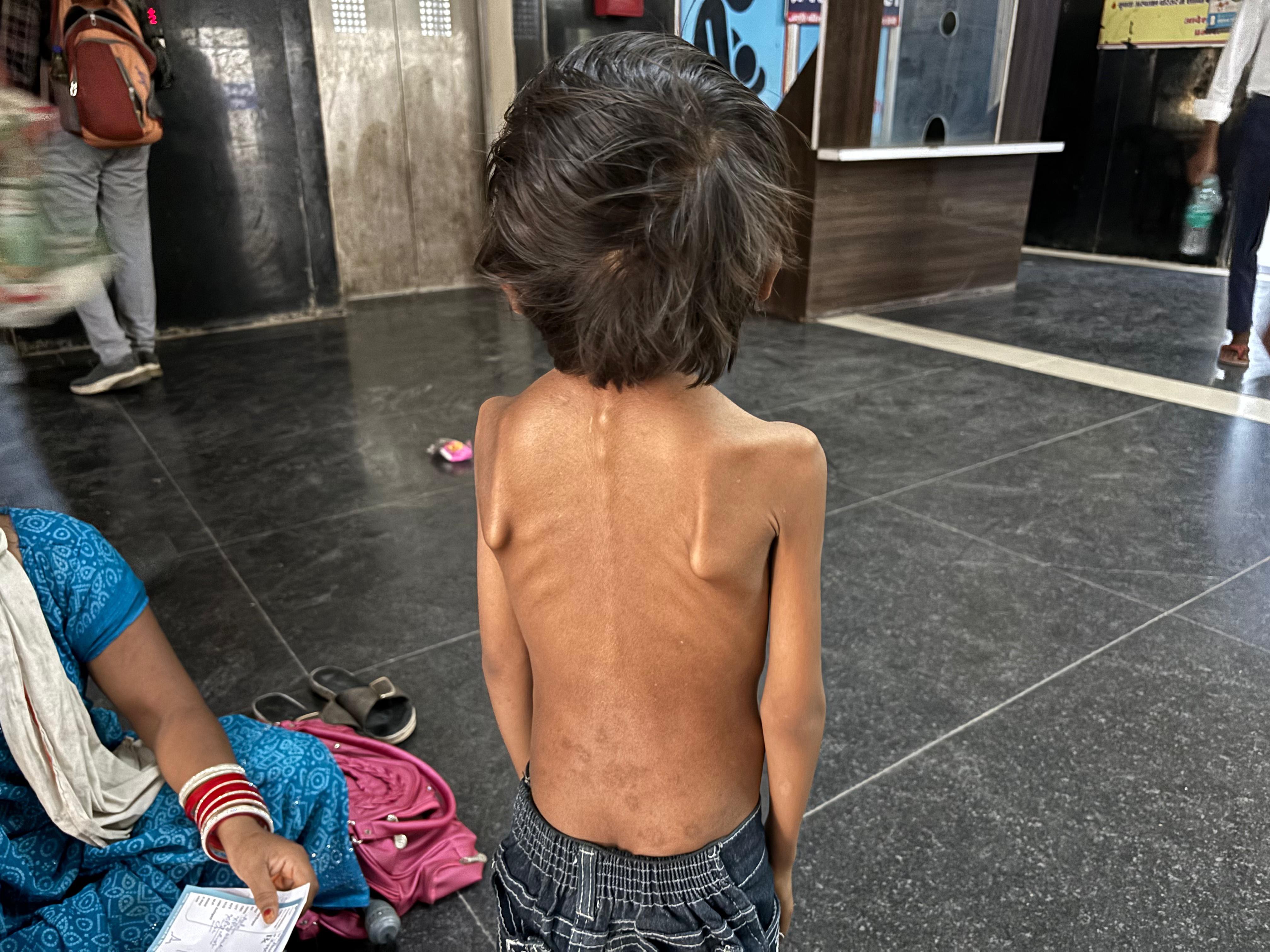 कुपोषण के लक्षणों से जूझ रहा मासूम, पीठ की हड्डी भी बाहर निकली।