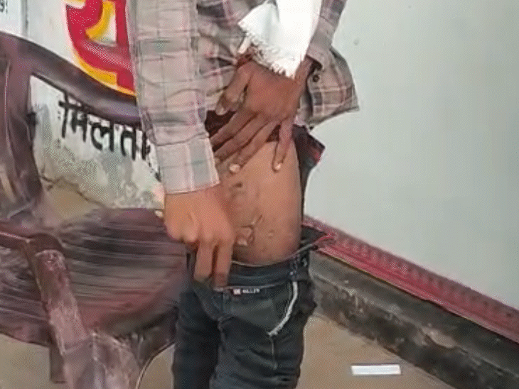 युवक की जेब में रखा मोबाइल अचानक फट गया। उसका पैर जल गया.