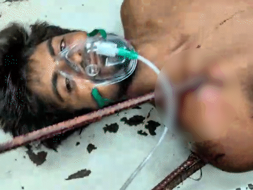 डॉक्टरों ने जटिल सर्जरी करके मरीज की जान बचाई।