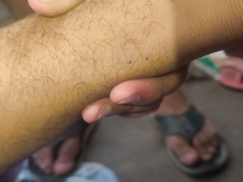 दाएं पैर पर सांप के काटने के निशान मिले।