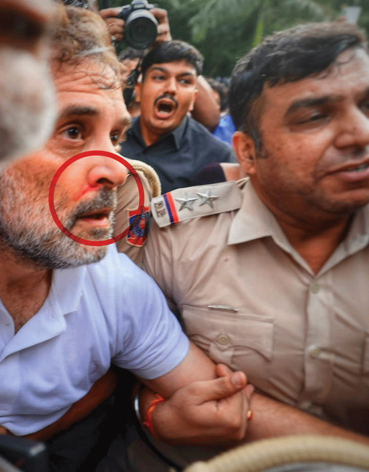 पुलिस के हिरासत में लेने के दौरान राहुल की नाक में लगी चोट की तस्वीर भी सामने आई। उनकी नाक के पास खून बह रहा था।
