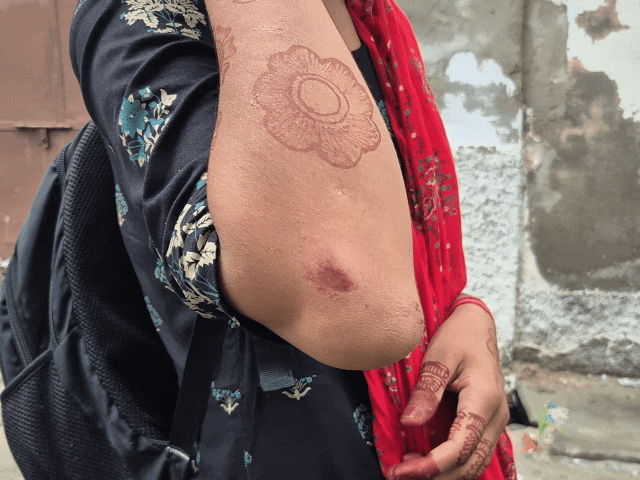 हादसे में छात्रा के हाथ, दाएं पैर और कमर में गंभीर चोटें आई हैं। वहीं उसका मोबाइल फोन भी पूरी तरह चकनाचूर हो गया।