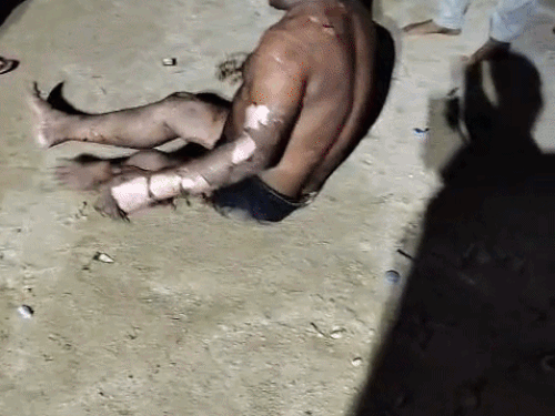 ब्लॉस्ट में झुलसा व्यक्ति।