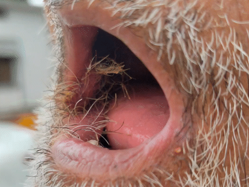 Hair grown in Mukesh Gambhir's mouth.