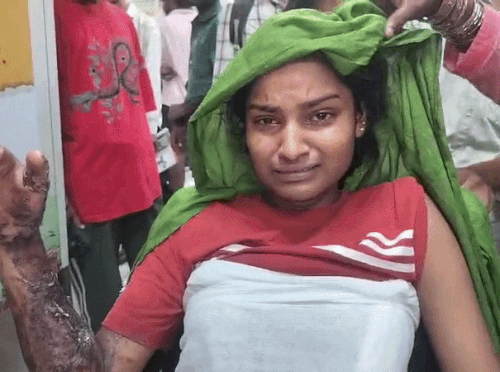 The young woman was first brought to BK Hospital for treatment, the young woman has suffered 50 percent burns