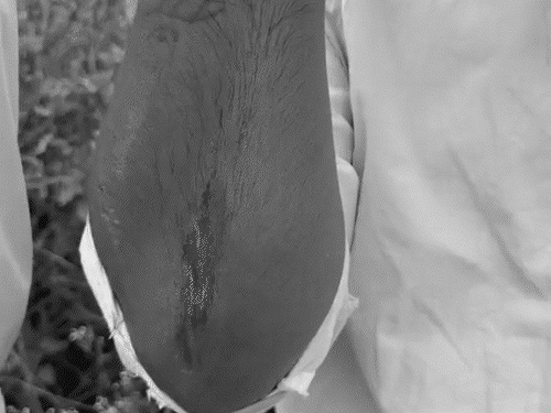 Injury sustained on the hand of CJP worker Sanju Verma during the scuffle and beating.