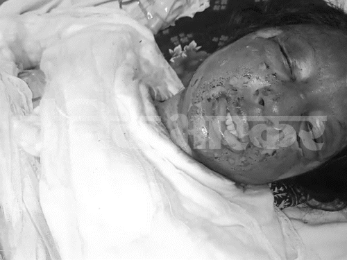अस्पताल में भर्ती लड़की पिता को पूरी घटना की जानकारी देती हुई। उसने बताया कि आरोपियों ने सैनिटाइजर डालकर एकदम से आग लगा दी।