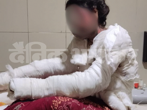 युवती का चेहरा भी पूरा जल गया। अभी तक अस्पताल में उसका इलाज जारी है।