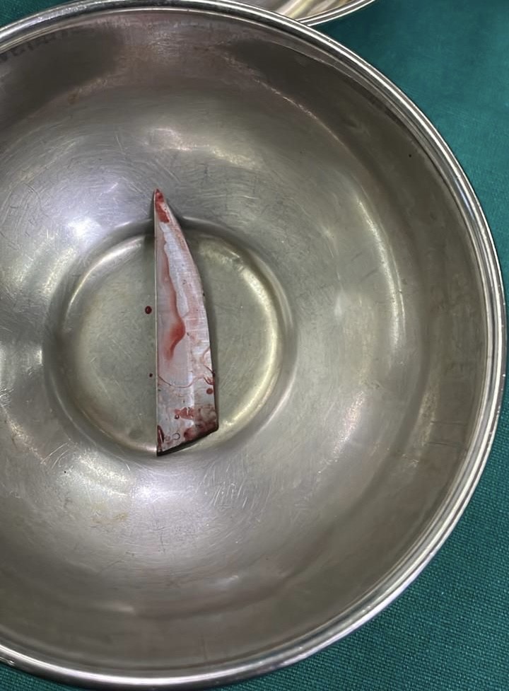 This piece of the knife was removed from Saif Ali Khan's back.