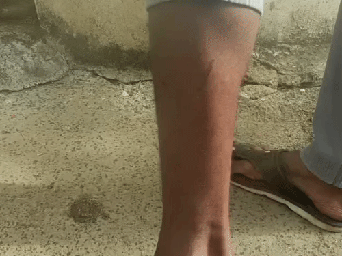 युवक के पैर पर कुत्ते के काटने के निशान हैं।