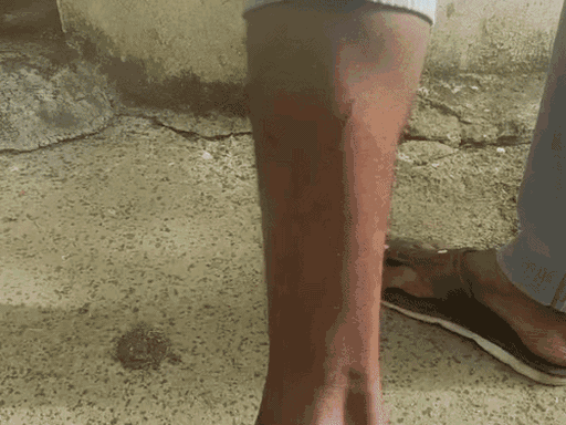 The young man had reached the hospital to get a rabies injection after being bitten by a dog.